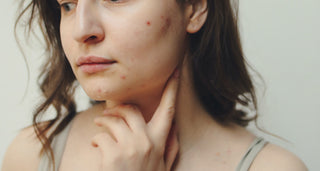 HORMONAL ACNE + YOUR PERIOD